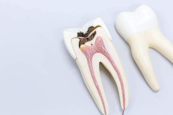 Ask a General Dentist: Is a Tooth Dead After a Root Canal from Creating Smiles Family Dental PC in Bloomfield, NJ
