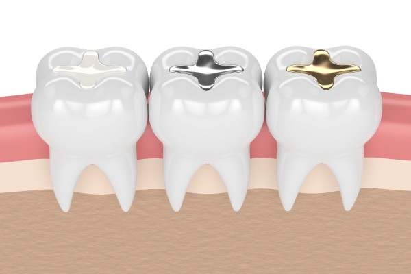 Types Of Dental Fillings By A General Dentist