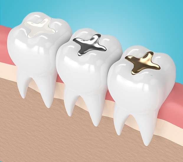 Bloomfield Tooth Colored Fillings