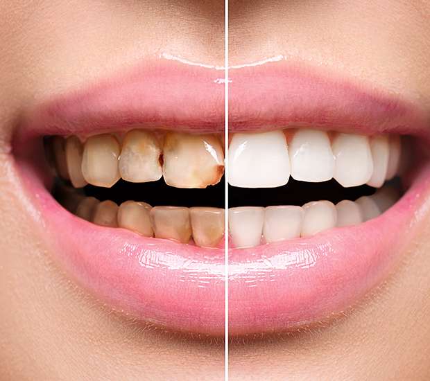 Bloomfield Dental Implant Restoration