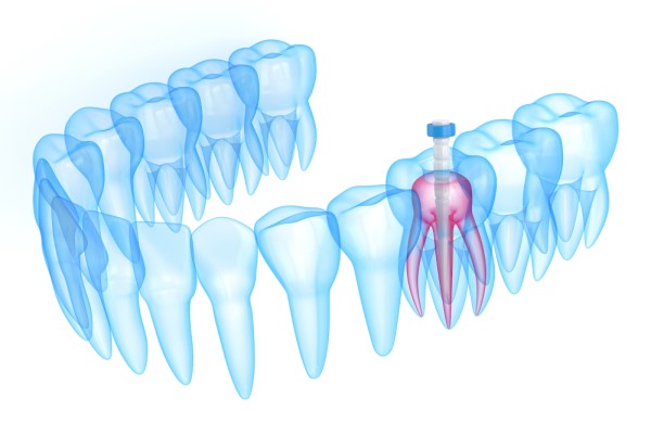 Root Canal Treatment Bloomfield, NJ