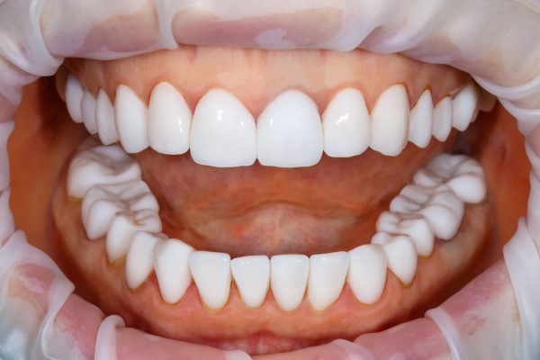 Ways Of Caring For Your Teeth After A Smile Makeover