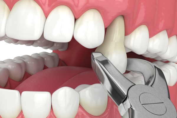 When Tooth Extraction Or Root Canal Therapy Is Recommended
